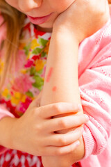 Child's arm with rash, Injured child suffering from scraped arm, bruises, Young girl's itchy arm, first aid, Kid's sensitive skin, red spots, childhood ailment