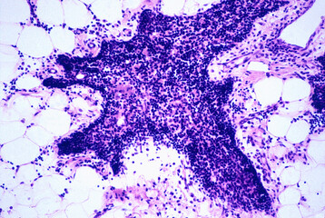 Human thymus. Involution