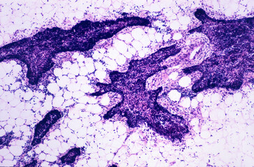 Human thymus. Involution