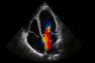 Ultrasound of the heart (photo)
