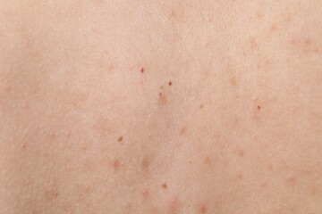 Fototapeta premium Woman with moles on her body, closeup