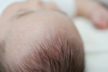 Fototapeta premium 生後5ヶ月の赤ちゃんの頭皮に見られる乾燥とフケ