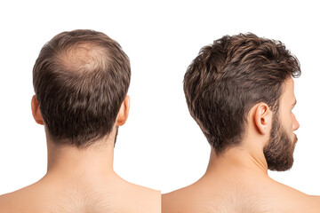 Hair loss treatment before and after results. Man's head with and without hair.