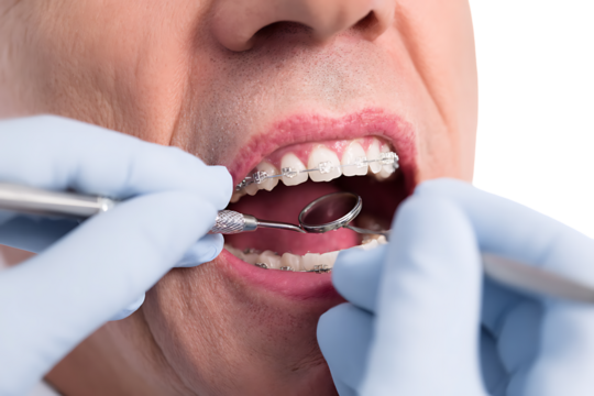 Close up of dentist examining patient's teeth with braces.