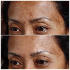 Close-up of forehead and temples, freckles faded, neighboring skin tone looks closer.