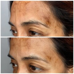 Close-up of forehead and temples, freckles faded, neighboring skin tone looks closer.