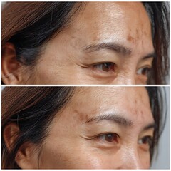 Close-up of forehead and temples, freckles faded, neighboring skin tone looks closer.