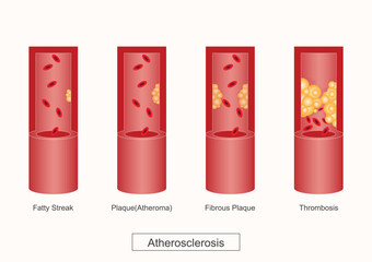 Atherosclerosis is a disease where plaque builds up inside arteries.