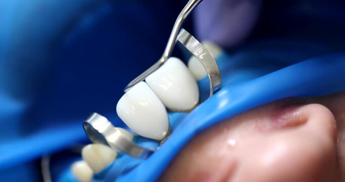 Dentist adjusts white dental crown with metal tool during procedure. Focused light surrounds patient creating clinical sterile atmosphere slow motion