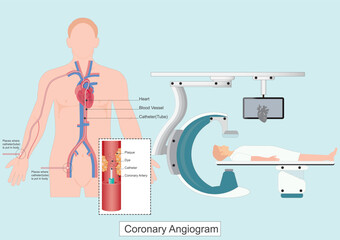 A coronary angiogram CAG is a test that uses X rays to look at the heart
