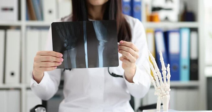 Female traumatologist holds x-ray picture of broken wrist near human palm bones model in clinic. Woman doctor controls patient injury recovery