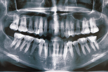 jaw X-ray, toothache, tooth care, treatment