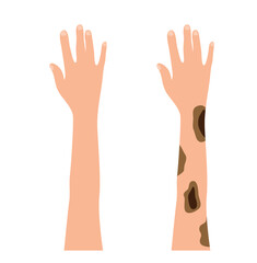Obraz premium Normal Hand and One with Melanoma Skin Cancer. Disease, health care and medicine vector art