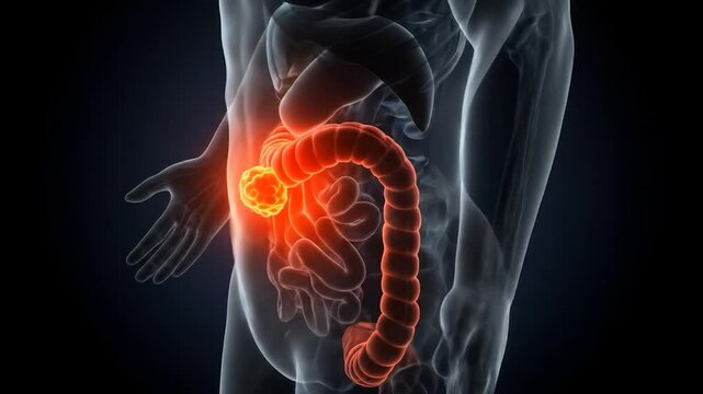 3D Colon Cancer Tumor Illustration (1)