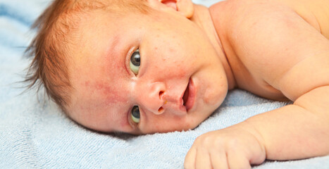 newborn baby lying down. jaundice pimples on skin. close-up portrait