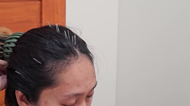 Front view, Acupuncture on the head to balance the body, reduce dizziness, headache, migraine. Restore the body that has lost its balance to return to balance.