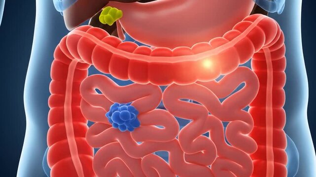 3D human digestive system, colon cancer tumor, medical illustration