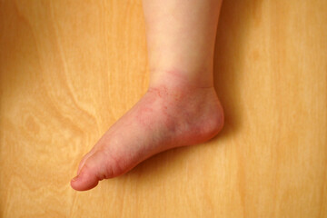 Swollen skin from mosquito bite on a child leg after outdoor play in summer