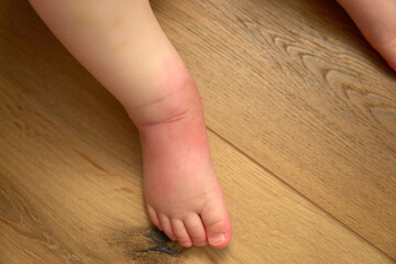 Visible knee has a distinct red mosquito bite surrounded by slight swelling from outdoor play.