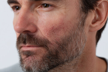 Obraz premium Close up of man with dry eczema flare on cheek showing rough, red, irritated skin and facial hair, highlighting skin condition and texture with natural light