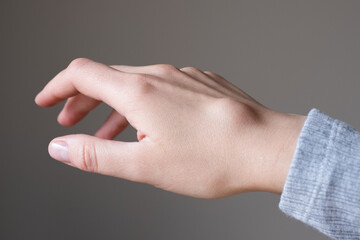 Female right back hand with ganglion cyst on the dorsum,  fluid-filled bump associated with a joint or tendon sheath, close-up view, selected focus.