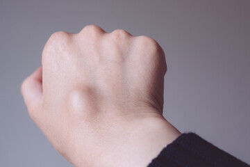 Female right back hand with ganglion cyst on the dorsum,  fluid-filled bump associated with a joint or tendon sheath, close-up view, selected focus.