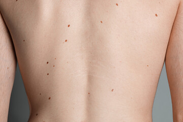 Man with moles on his body against grey background, closeup