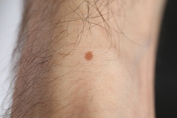 Man with mole on his body against dark background, closeup