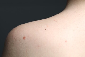 Woman with moles on her skin against grey background, macro view