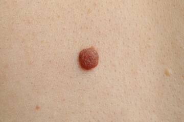 Woman with mole on her skin, macro view