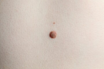 Woman with mole on her skin, macro view