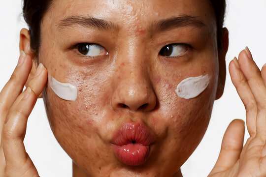 Portrait of Asian woman with severe acne and skin imperfections, unretouched beauty campaign for skincare diversity,applies cream, high-resolution close-up in studio lighting
