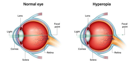 Normal Eye vs Hyperopia (Farsightedness) – Comparative Eye Anatomy Vector
