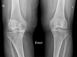 bilateral erect AP (anteroposterior) knee X-ray.