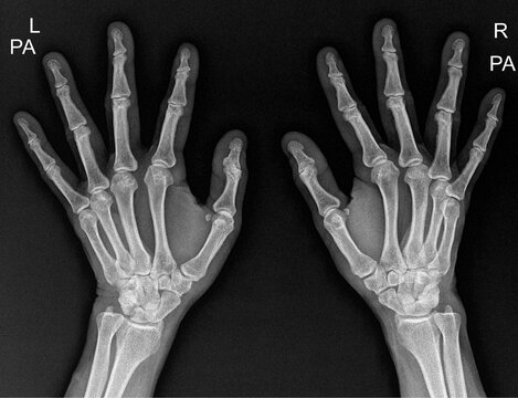  Bilateral PA (posteroanterior) view of both hands.