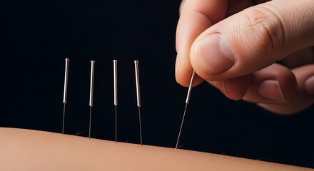 A close-up view of an arm receiving acupuncture treatment with needles.