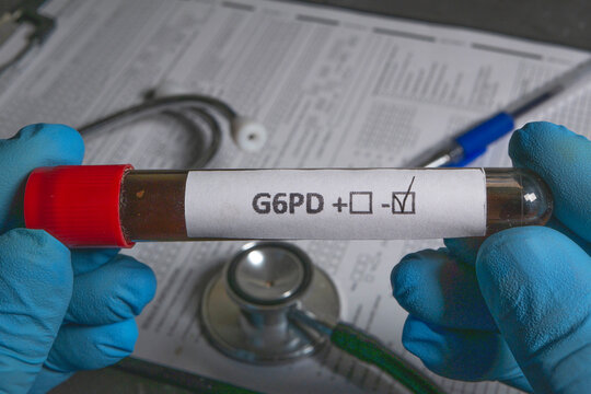 Doctor holding blood sample with positive g6pd test result