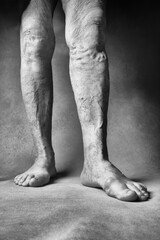 Legs of an elderly woman. Varicose veins on a female legs. The concept of accepting old age and beauty in old age. Toned image, black and white image.