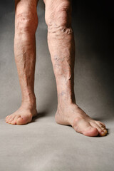 Varicose Veins on Elderly Woman's Legs. Varicose veins on a female legs. Selective focus