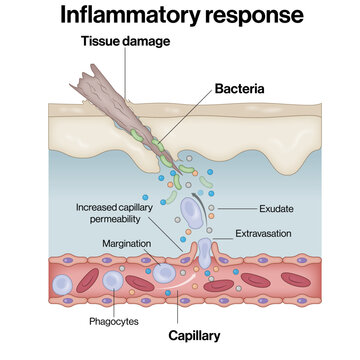 Inflammatory Response Mechanism &ndash; Tissue Injury, Bacterial Invasion, and Phagocyte Recruitment Vector Illustration