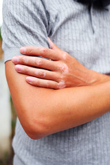 Detail of vitiligo on tanned skin healthcare, dermatology, uniqueness and identity.
