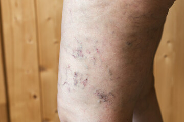 Close-up of a human leg with visible spider veins and varicose veins under the skin, concept of vascular disease and venous circulation problems, health and medical condition