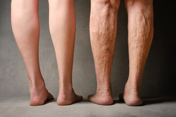 Legs of an elderly and young woman. Comparison of the legs of a young and old woman. Varicose veins...