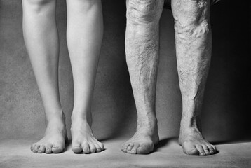  Comparison of the legs of a young and old woman. Varicose veins on a female legs. Youth and old...