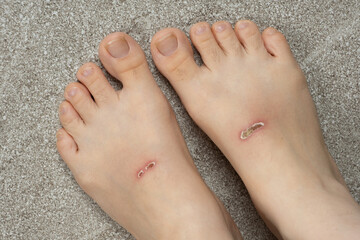 Abrasions on Top of Feet After Swimming with Fins