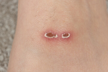 Fototapeta premium Injured Dorsal Side of Feet from Swim Flippers