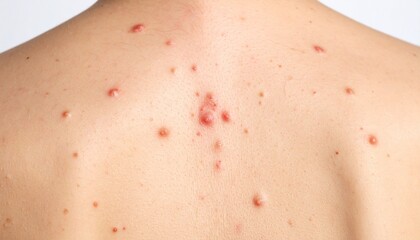 A close-up view of human back skin affected by a skin disease