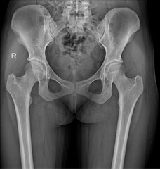 AP pelvic X-ray showing intact pelvic ring and hip joints without acute fracture or hardware.