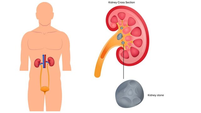 Human kidney Stone Animation, Animation of Kidney stone treatment