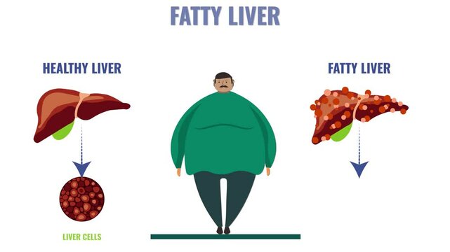 Understanding Fatty Liver Causes Symptoms and Treatment Options